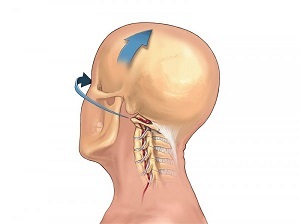 jak se projevuje osteochondróza krční páteře