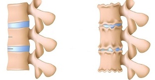 jak rozpoznat přítomnost osteochondrózy bederní páteře