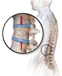 Osteoporóza vyvolává bolesti zad v bederní oblasti